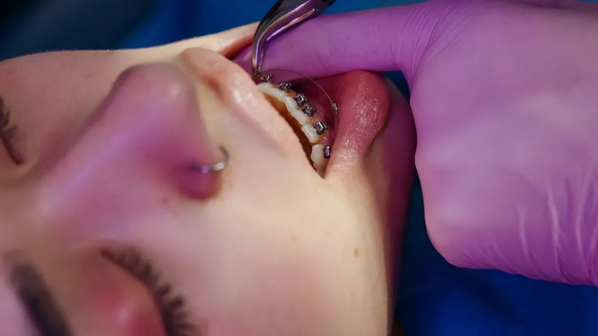 Close-up of a dental professional in purple gloves working on a patient's braces