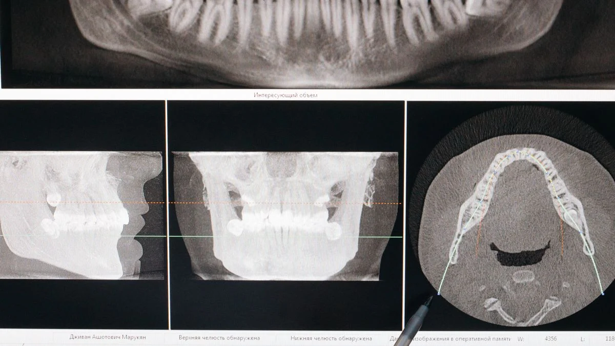 A dental professional analyzing a dental X-ray on a computer screen
