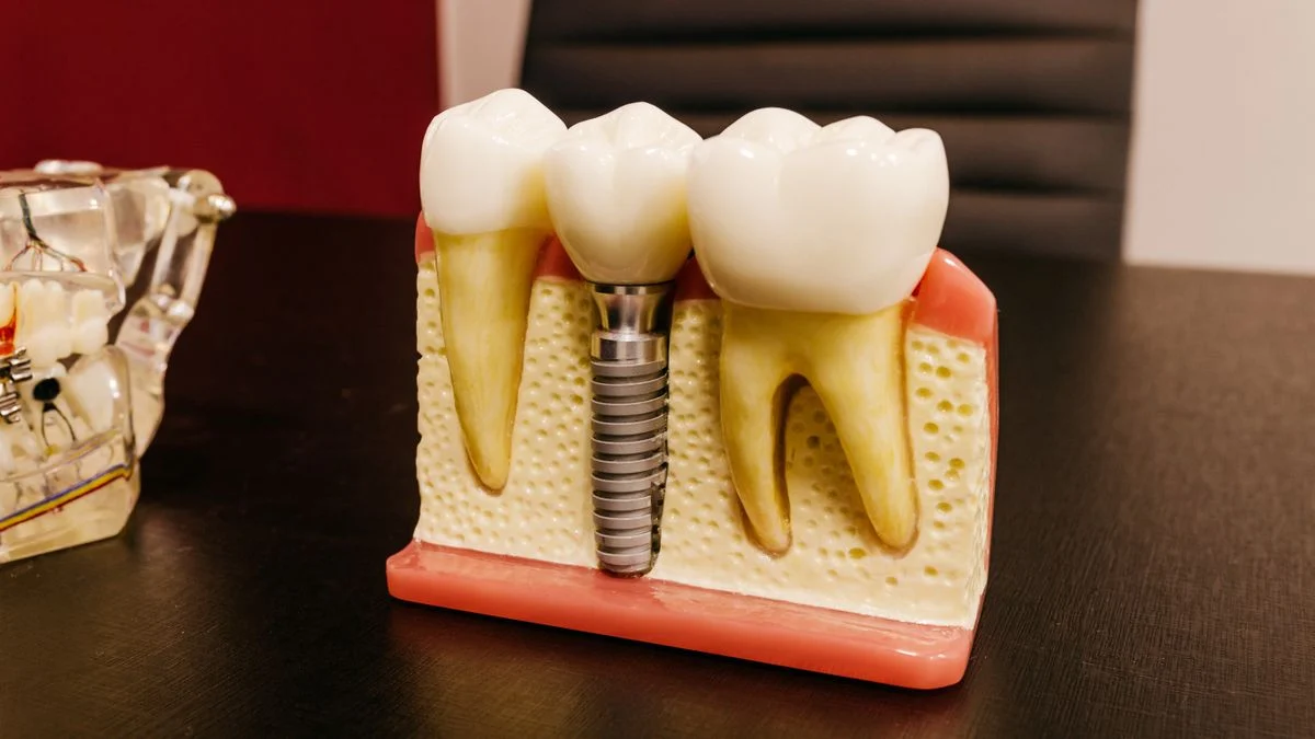Ceramic dental implants fitted into an artificial jaw model on a clinic desktop