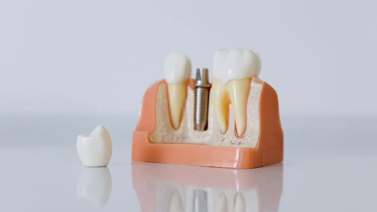 Close-up of a dental implant model featuring artificial teeth and the jaw structure an implant is anchored into