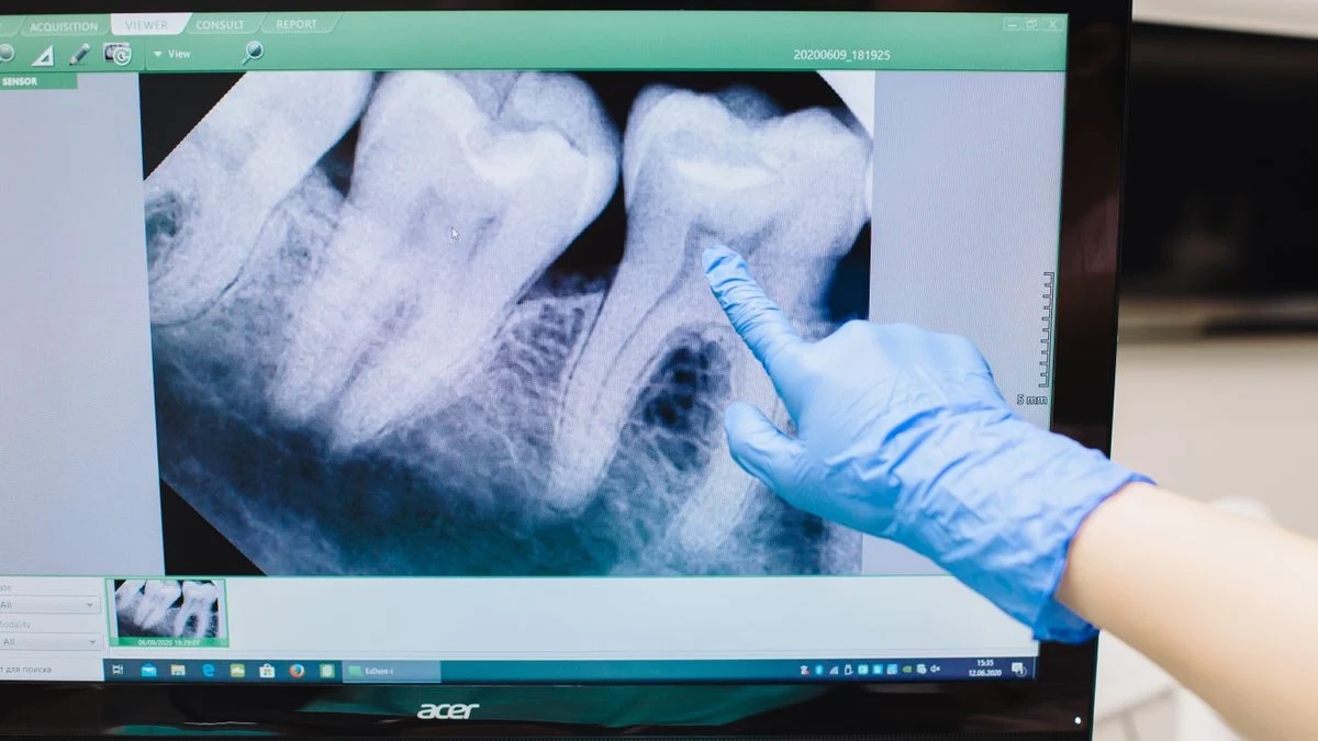 Gloved hand pointing at a dental X-ray on a monitor while assessing whether a root canal is needed